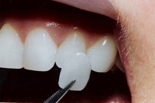 Laminate Teeth | Dent Elitium