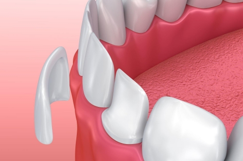 Dental Bonding | Dent Elitium